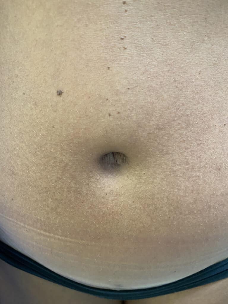 After Image: Post-Abdominoplasty Umbilicus - front