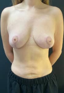 After Image: Breast Lift