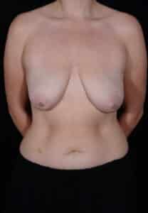 Before Image: Breast Lift
