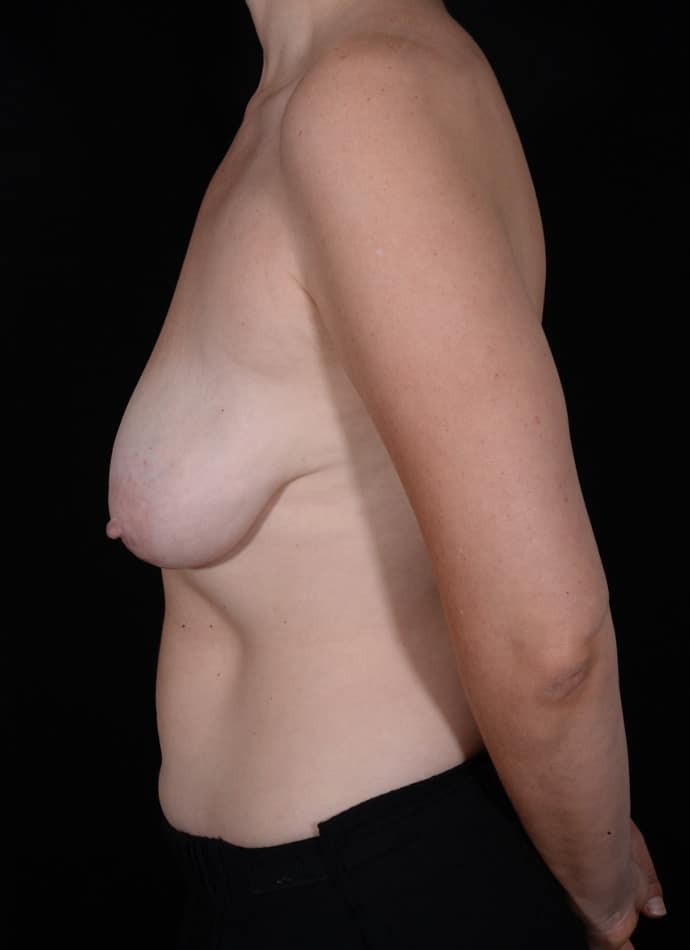 Before Image: Breast Lift - left-side