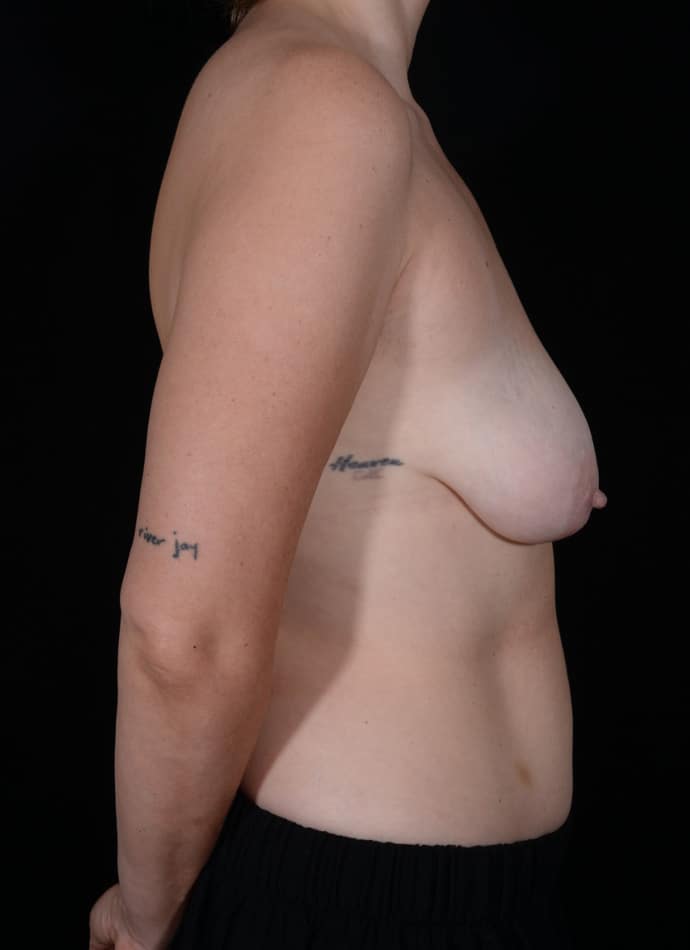 Before Image: Breast Lift - right-side