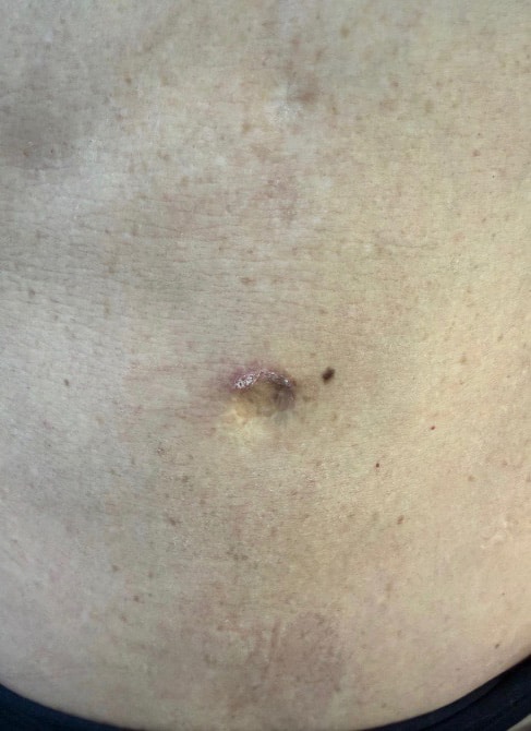 After Image: Umbilicoplasty - front