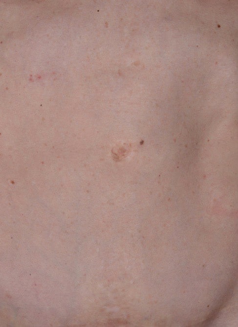 Before Image: Umbilicoplasty - front