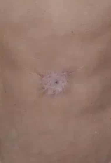 Before Image: Umbilicoplasty - front