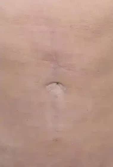 After Image: Umbilicoplasty - front