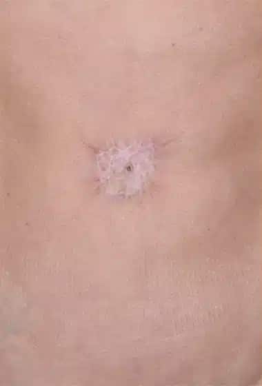 Before Image: Umbilicoplasty - front