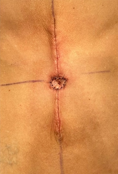 After Image: Umbilicoplasty - front