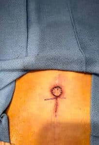 After Image: Umbilicoplasty