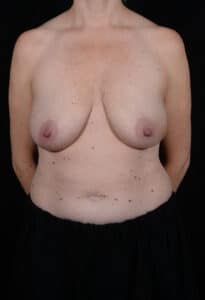 Before Image: Mommy Makeover