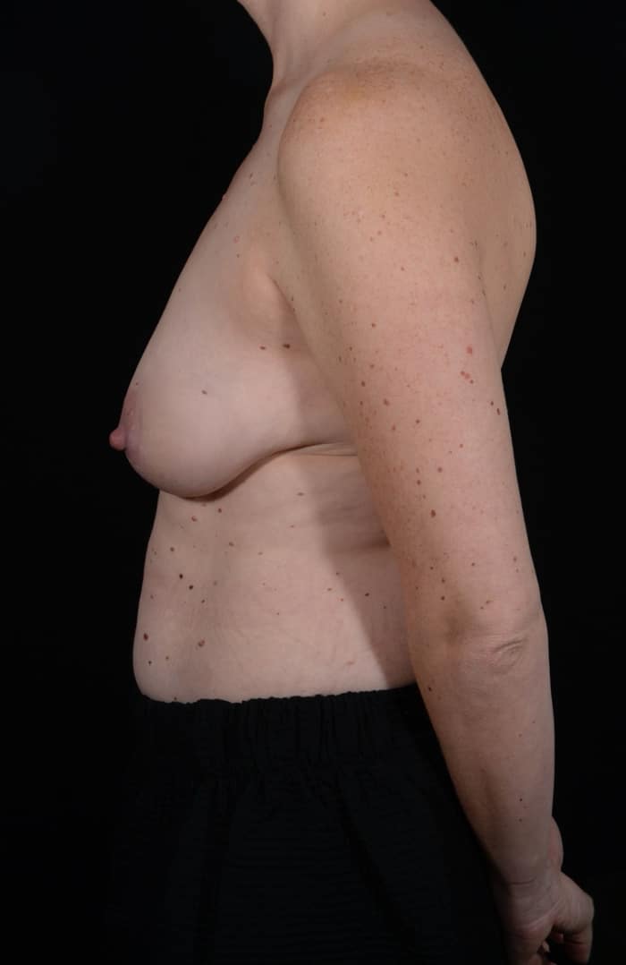 Before Image: Breast Lift - left-side