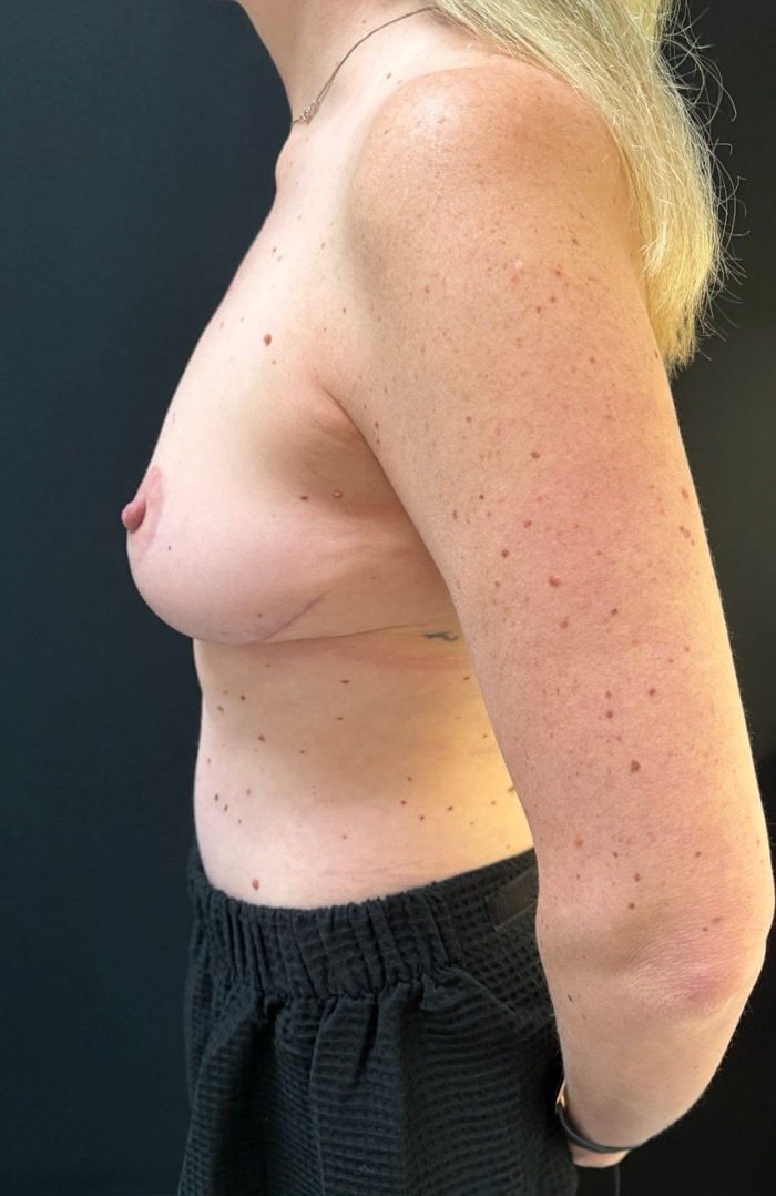 After Image: Breast Lift - left-side