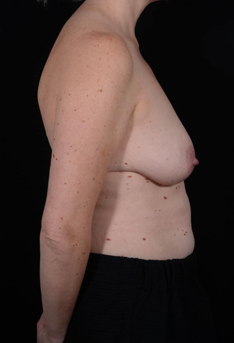 Before Image: Breast Lift - right-side