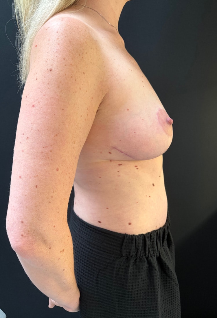 After Image: Breast Lift - right-side