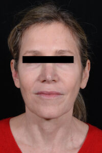 Before Image: Facelift