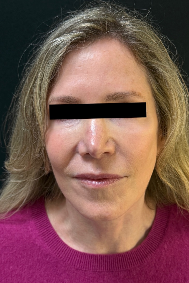 After Image: Facelift - front