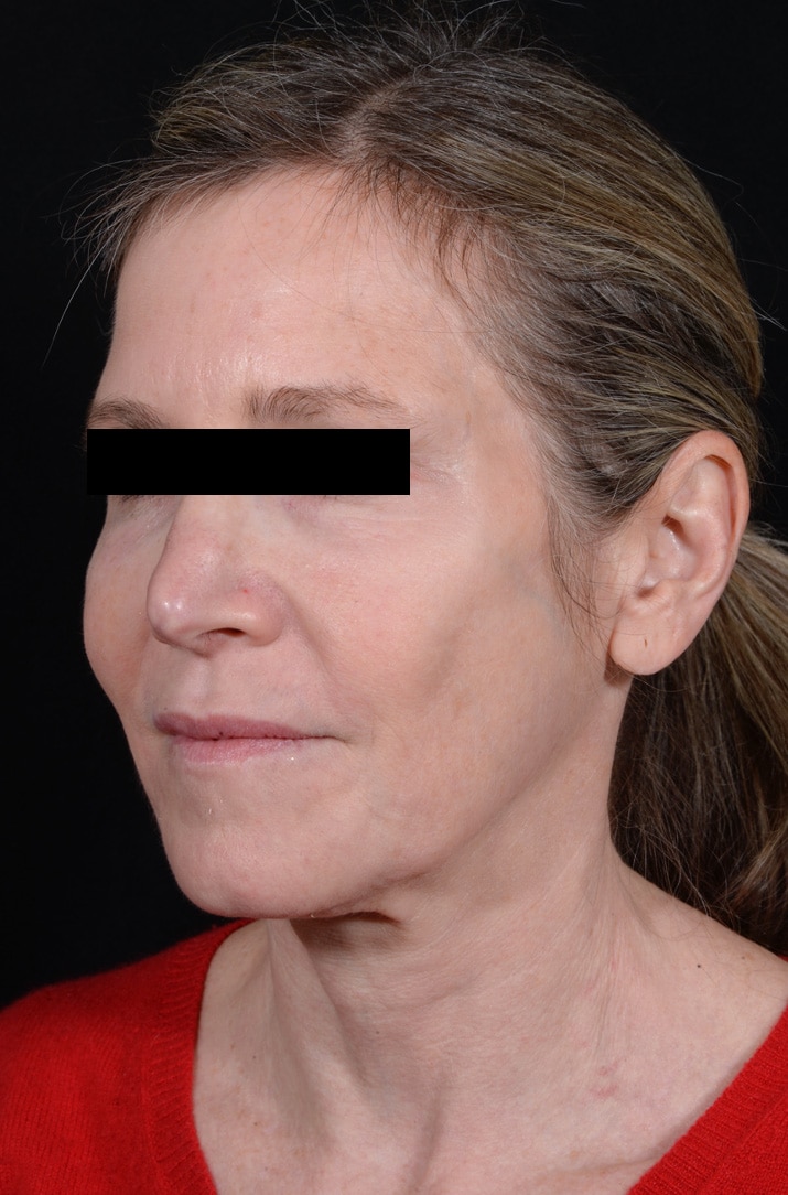 Before Image: Facelift - left-front-oblique