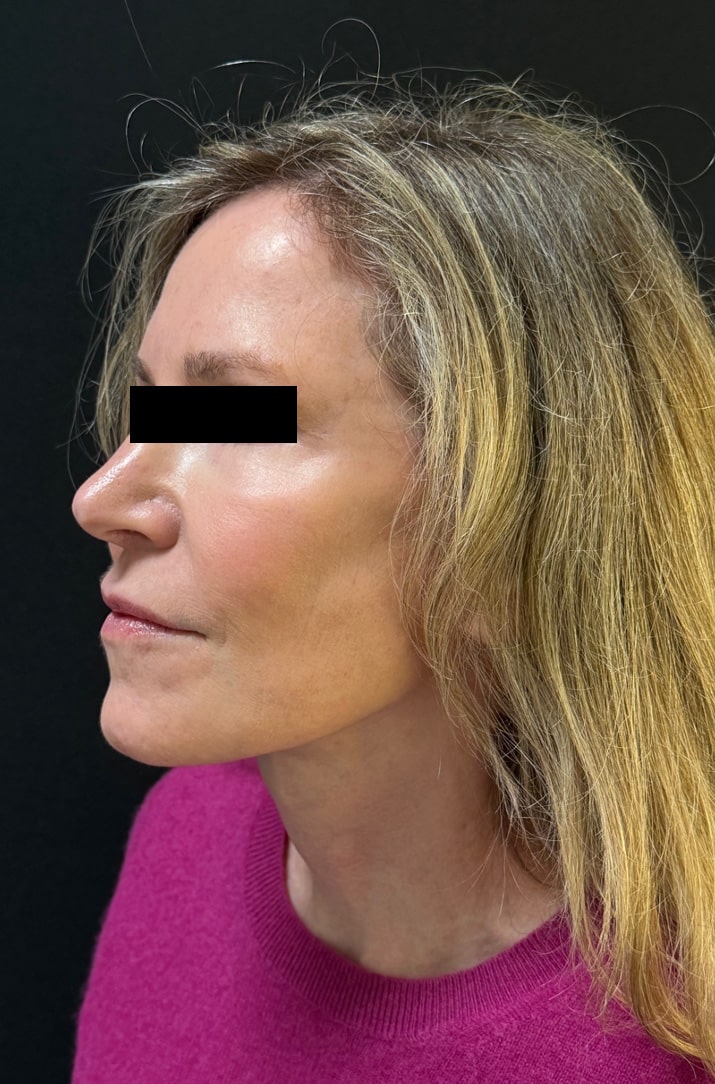 After Image: Facelift - left-front-oblique
