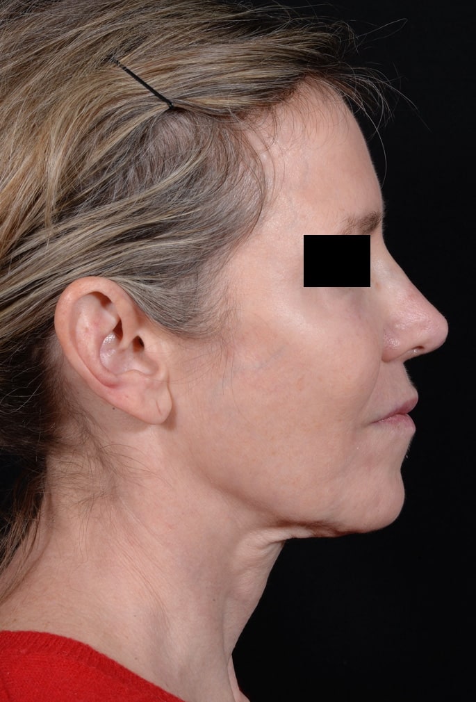 Before Image: Facelift - right-side