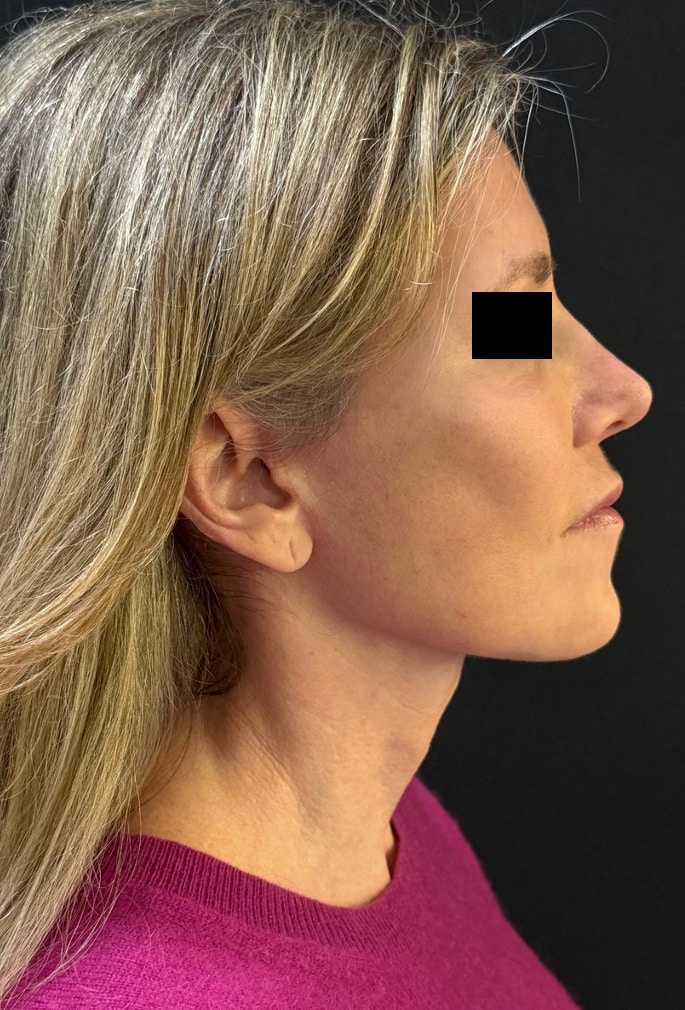 After Image: Facelift - right-side