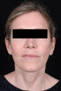 After Image: Facelift