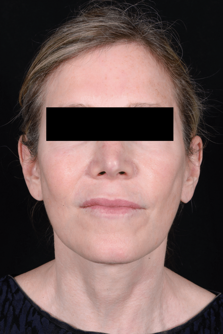 After Image: Facelift - front