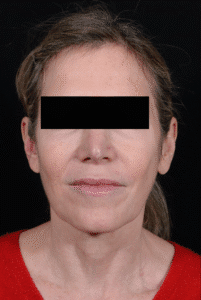 Before Image: Facelift