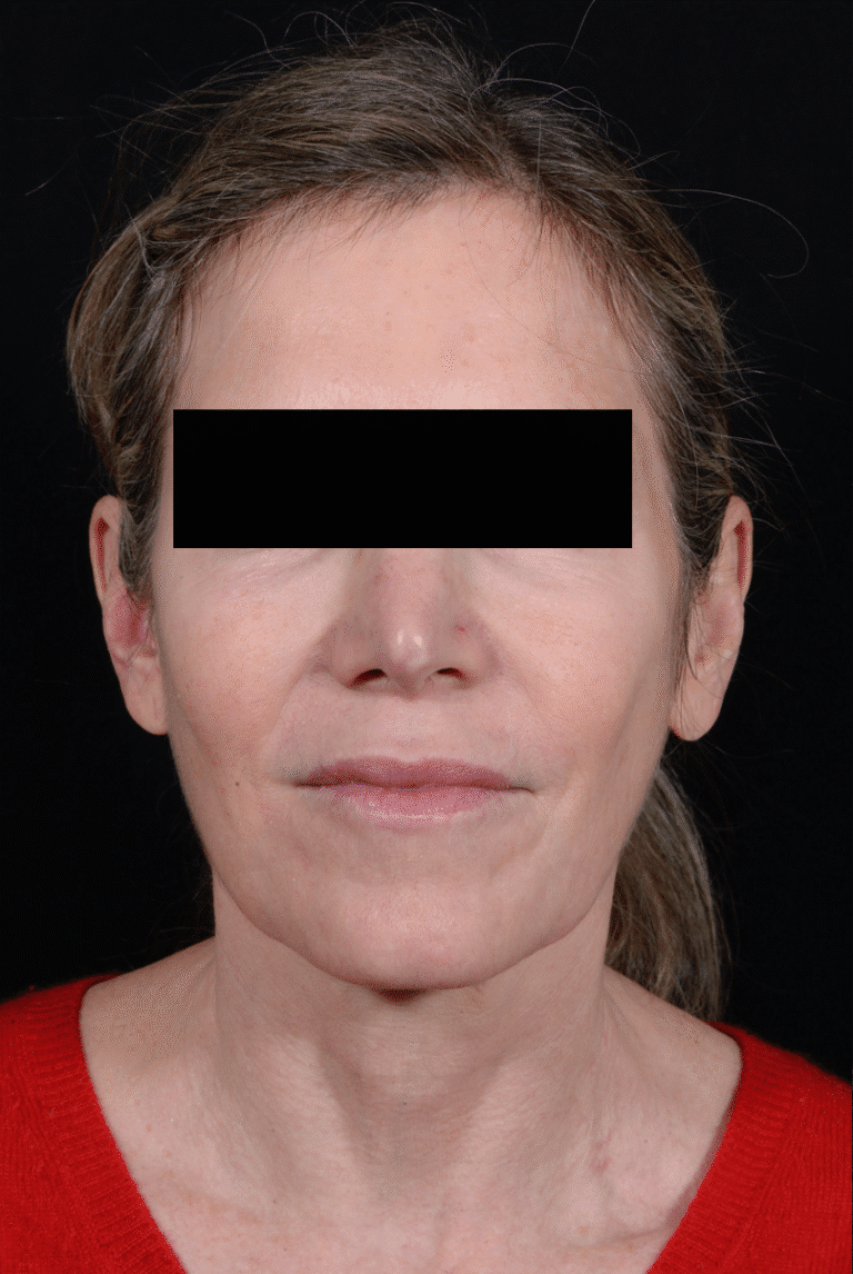 Before Image: Facelift - front