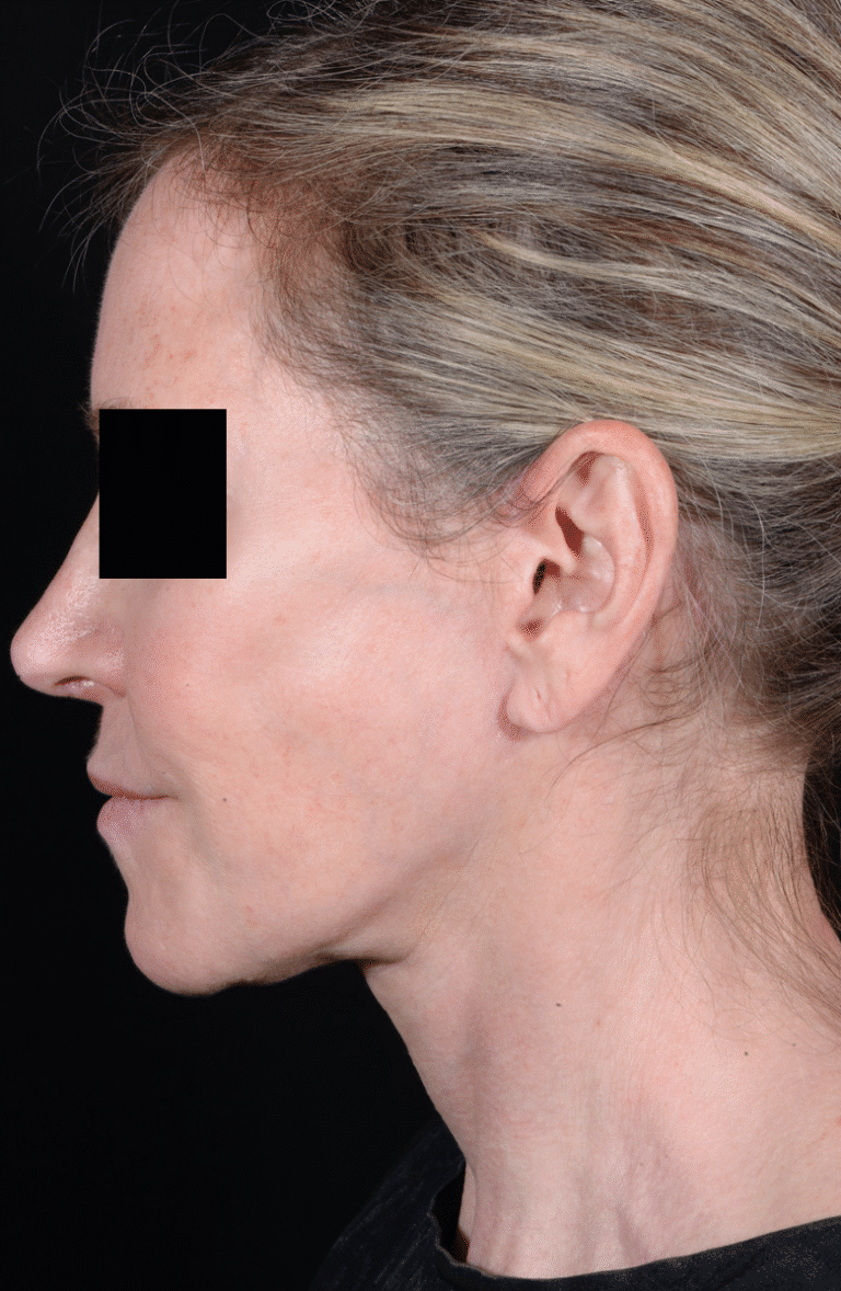 After Image: Facelift - left-side