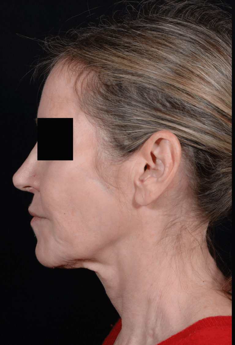 Before Image: Facelift - left-side
