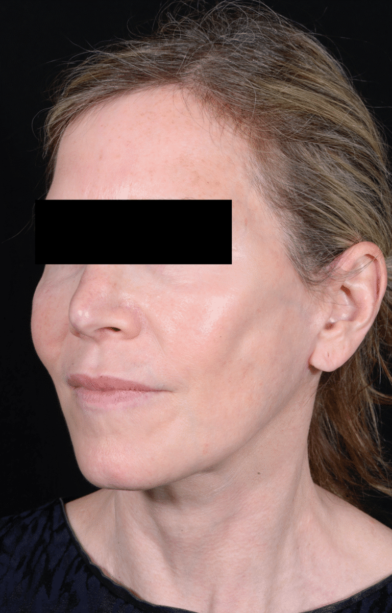 After Image: Facelift - left-front-oblique