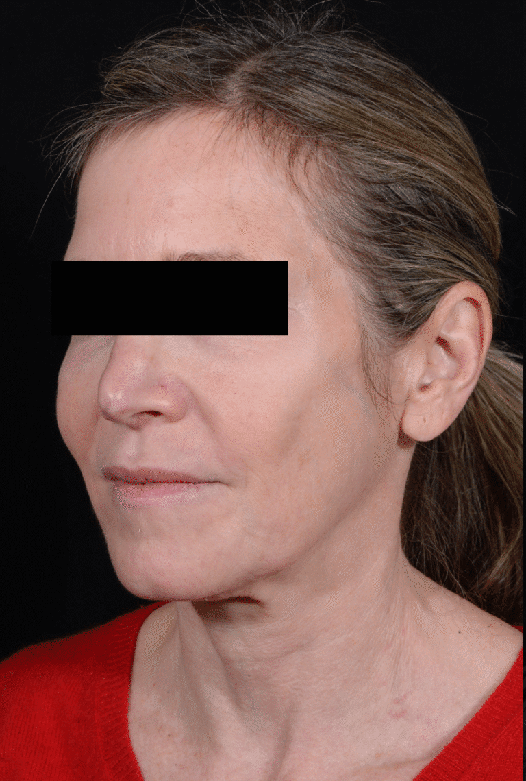 Before Image: Facelift - left-front-oblique