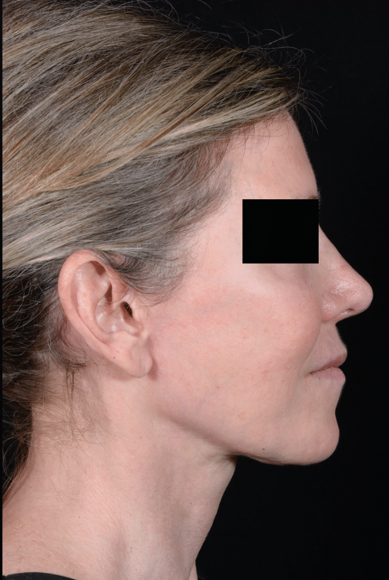 After Image: Facelift - right-side