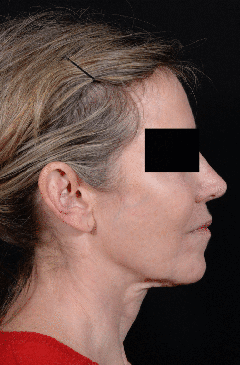 Before Image: Facelift - right-side