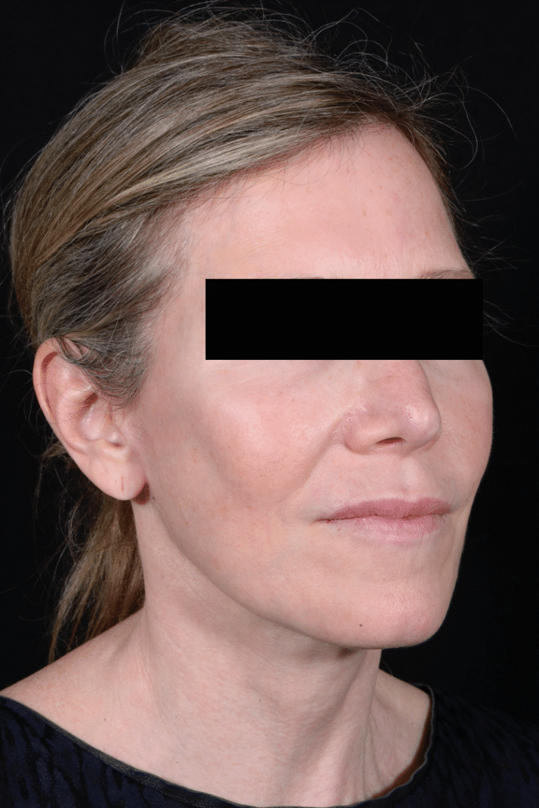 After Image: Facelift - right-front-oblique