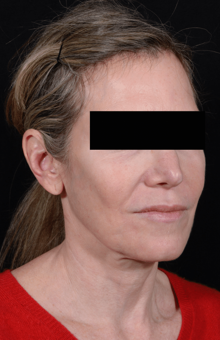Before Image: Facelift - right-front-oblique