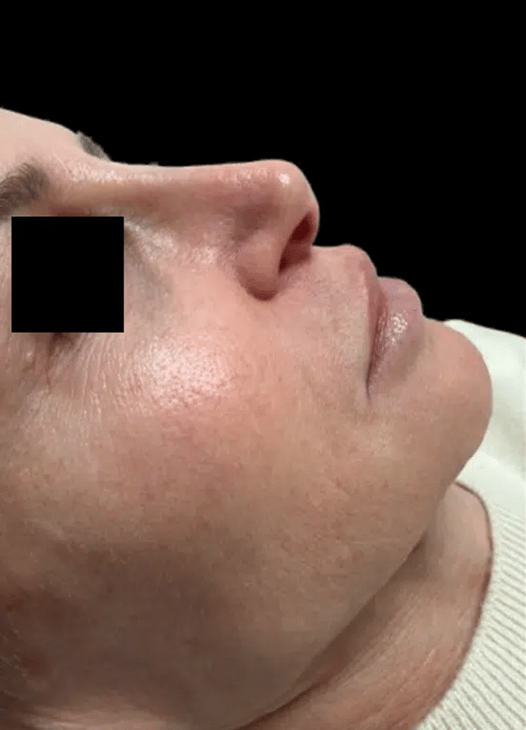 Before Image: Rhinoplasty - right-side