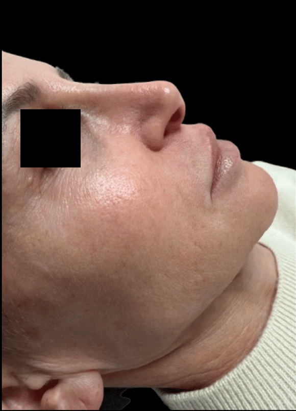 Before Image: Rhinoplasty - right-side