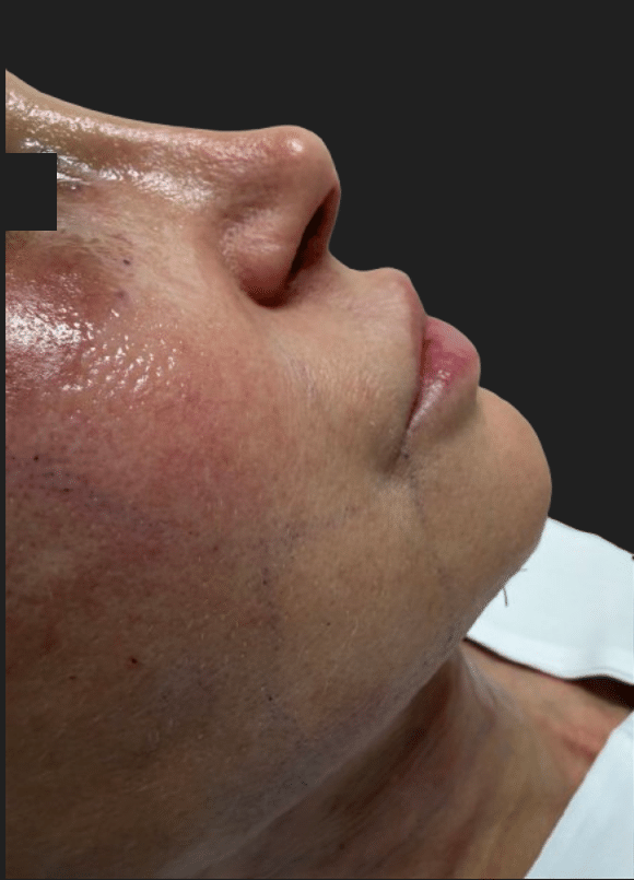 After Image: Rhinoplasty - front