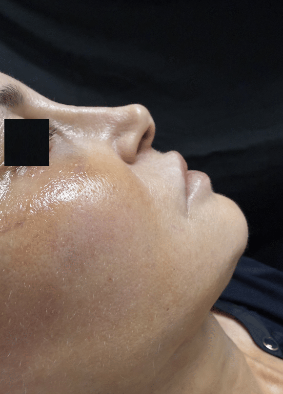 After Image: Rhinoplasty - right-side