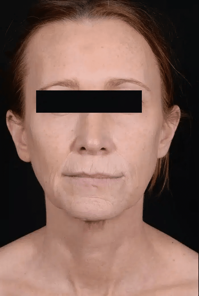Before Image: Laser Resurfacing - front