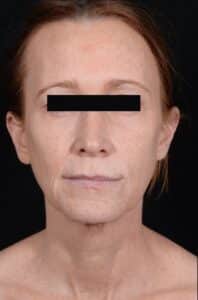 Before Image: Facelift & Laser Resurfacing
