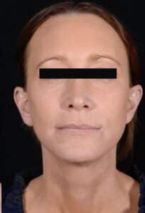 After Image: Facelift & Laser Resurfacing