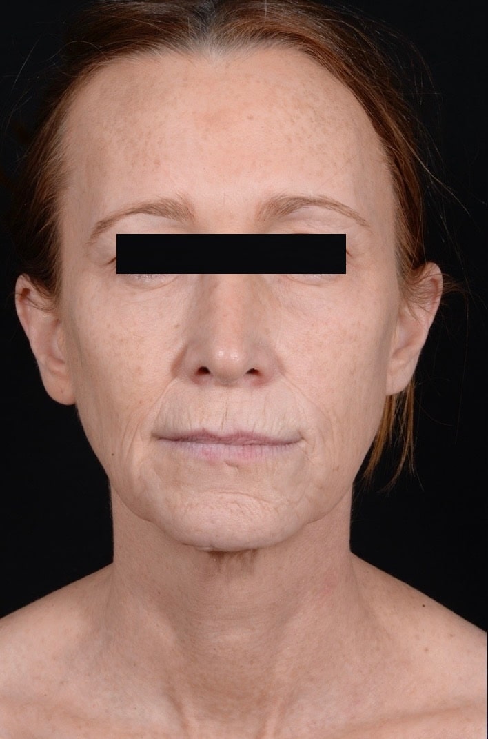 Before Image: Facelift & Laser Resurfacing - front
