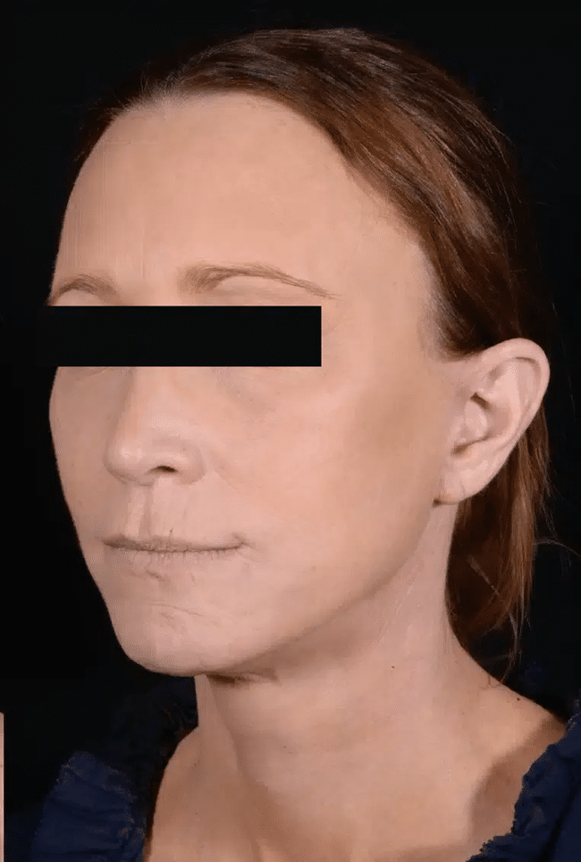 After Image: Laser Resurfacing - left-front-oblique