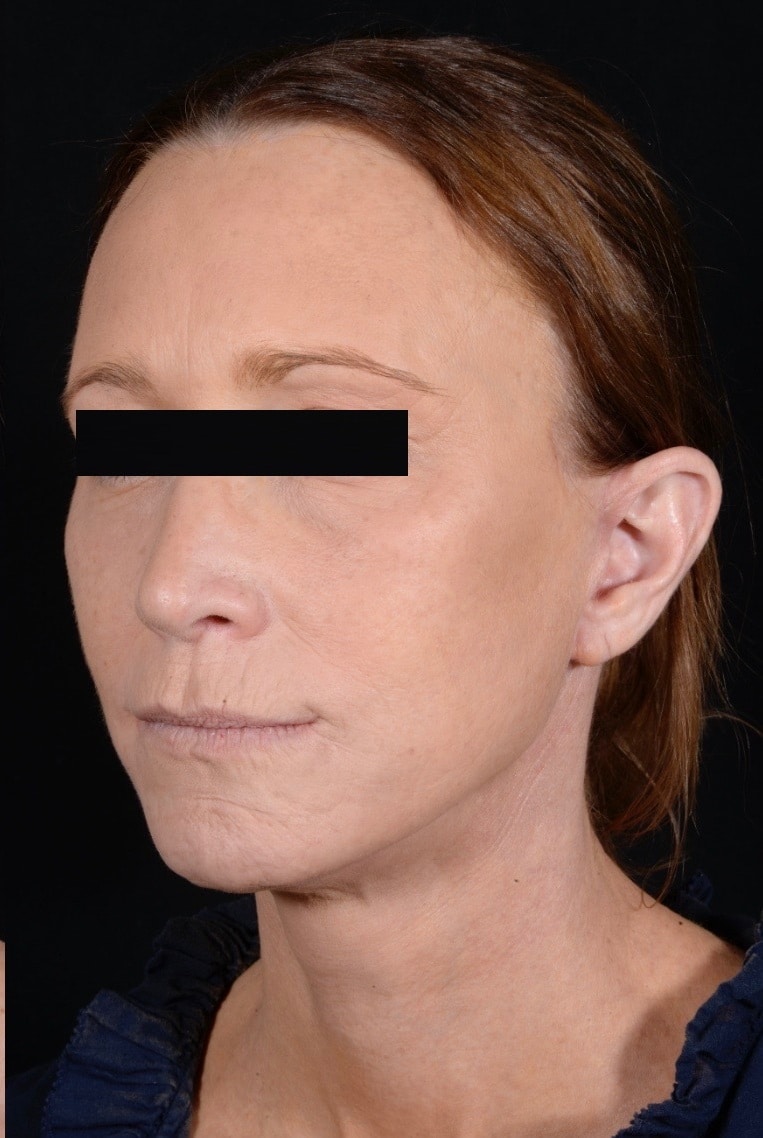 After Image: Facelift & Laser Resurfacing - left-front-oblique