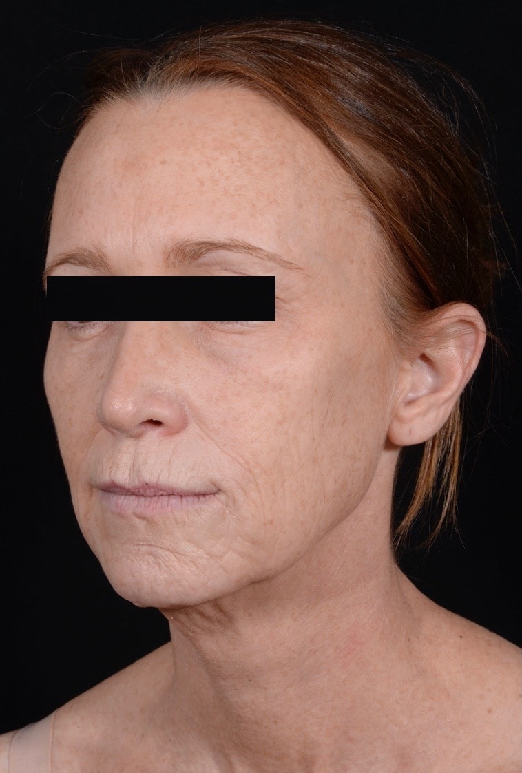 Before Image: Facelift & Laser Resurfacing - left-front-oblique