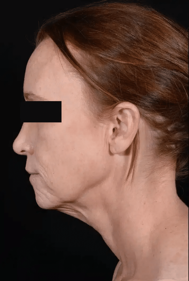 Before Image: Laser Resurfacing - left-side