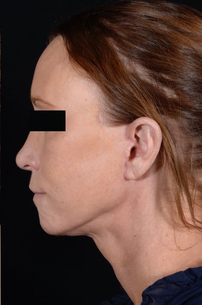 After Image: Facelift & Laser Resurfacing - left-side