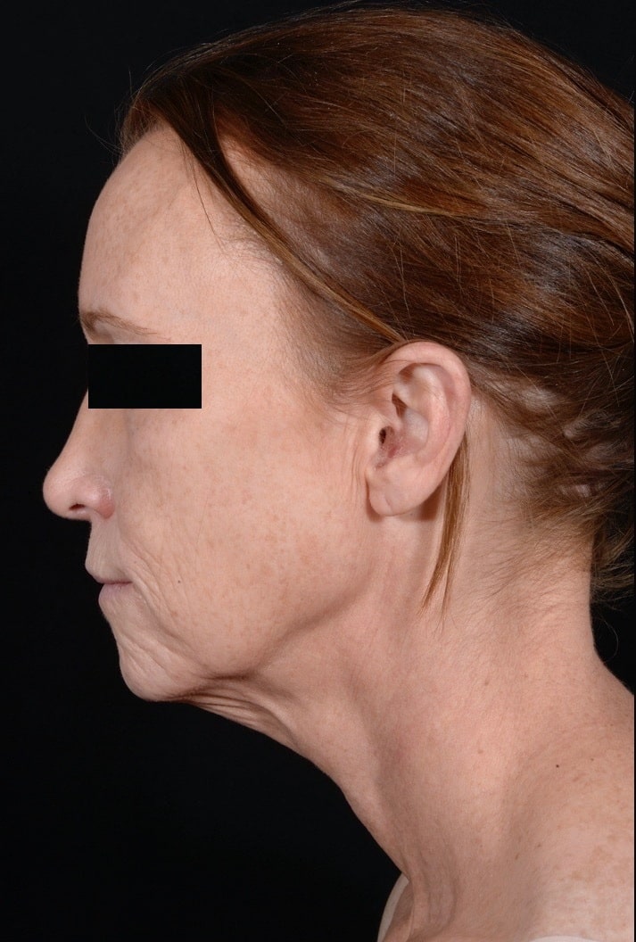 Before Image: Facelift & Laser Resurfacing - left-side