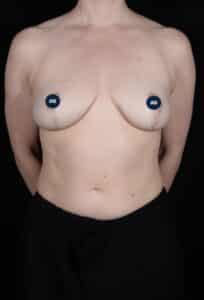 After Image: Breast Lift